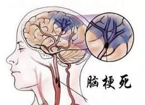 记住5个1活到百岁不脑梗! 记住5个1活到百岁不脑梗!